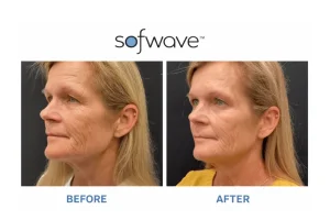 The Skin Tightening Treatment Everyone in the Industry Is Talking About (And Why It Has Zero Downtime)
