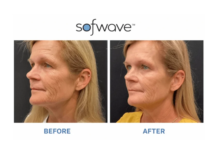 Skin Tightening